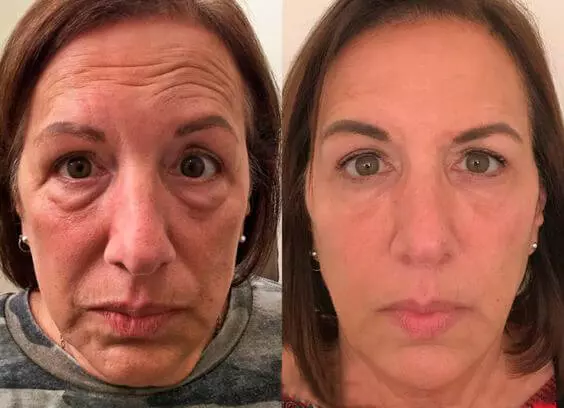 Antes e depois do uso de Skin Gota Trans-resveratrol mostrando redução de rugas