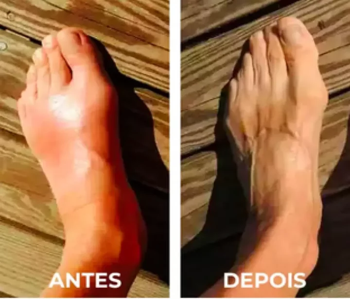 Antes e Depois de um pé inchado e um pé saudável